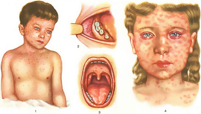 Први знаци на морбили – како да се препознаат симптомите?