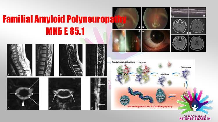 Што се фамилијарни амилоидни полиневропатии?