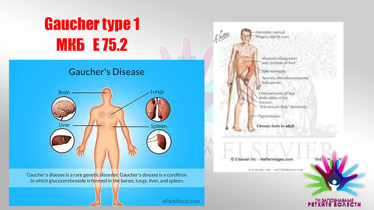 Првпат од пред десет дена е достапна орална терапија за пациентите со ретката болест Гоше