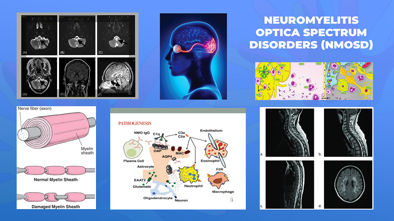 Ги запознаваме ретките болести: Неуромиелитис оптика спектар на нарушувања