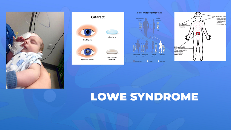 Ги запознаваме ретките болести: Лоу синдром