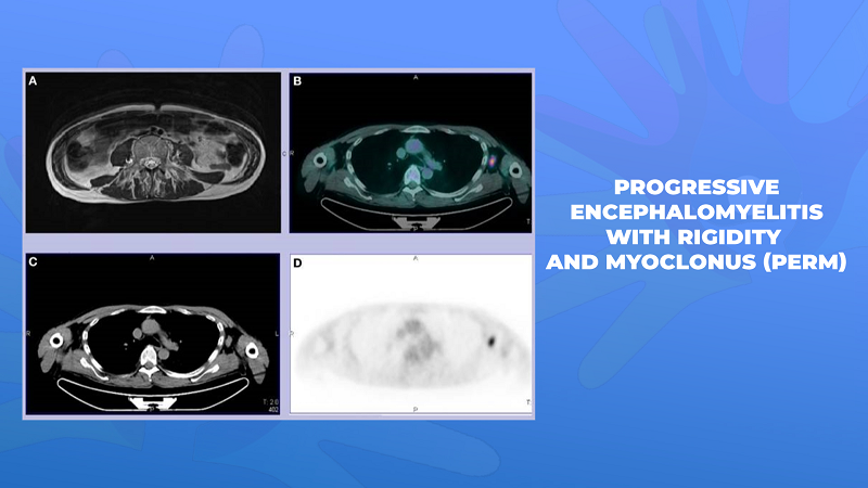 Ги запознаваме ретките болести: Прогресивен енцефаломиелитис со ригидитет и миоклонус (ПЕРМ)