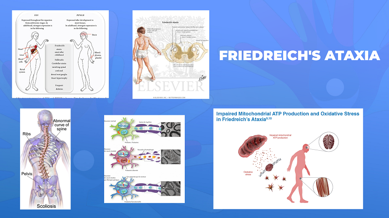 Ги запознаваме ретките болести: Фридрајхова атаксија