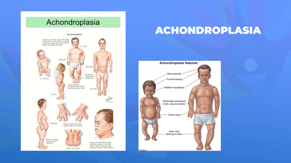 Ги запознаваме ретките болести: Ахондроплазија