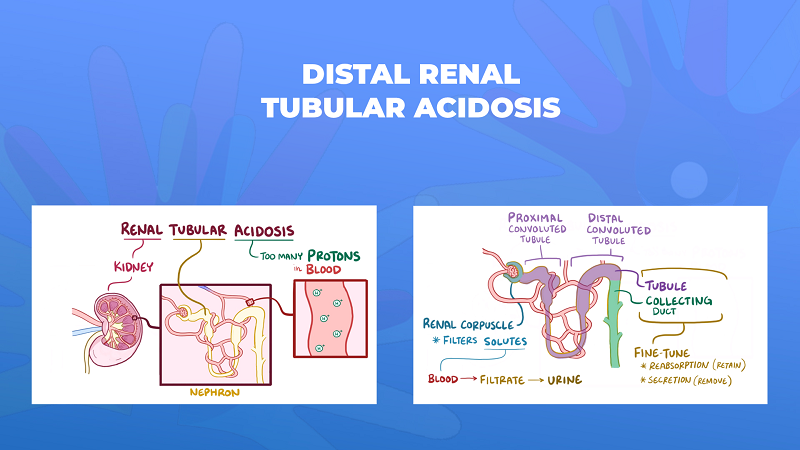 Ги запознаваме ретките болести: Дистална бубрежна тубуларна ацидоза