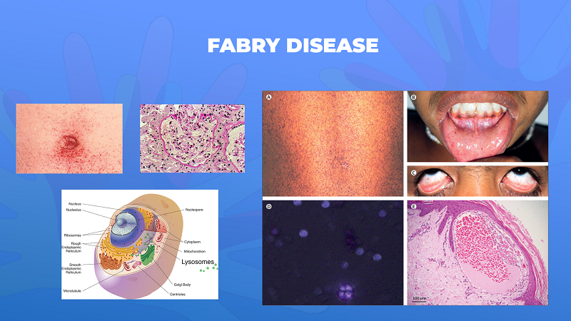 Ги запознаваме ретките болести: Фабри болест