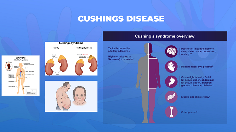 Ги запознаваме ретките болести: Болест на Кушинг