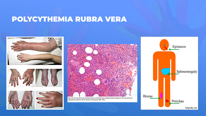 Ги запознаваме ретките болести: Полицитемија Рубра Вера