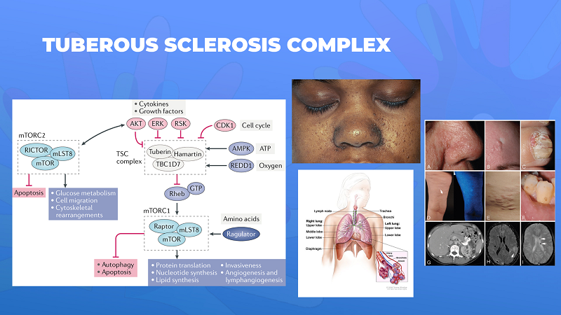 Ги запознаваме ретките болести: Туберозна склероза комплекс