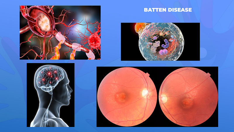 Ги запознаваме ретките болести: Батенова болест