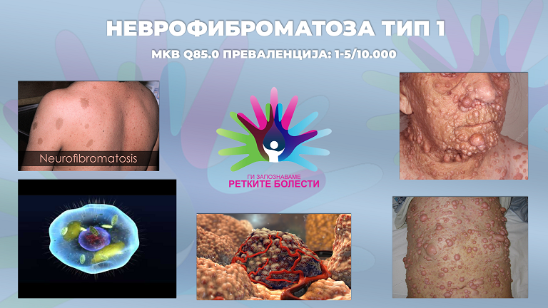 Ги запознаваме ретките болести: Неврофиброматоза тип 1