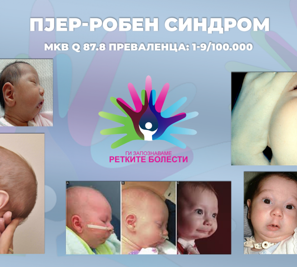 Ги запознаваме ретките болести: Пјер-Робен синдром