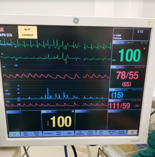 Пацинетот на кој му беше направена трансплантација на срце се чувствува добро