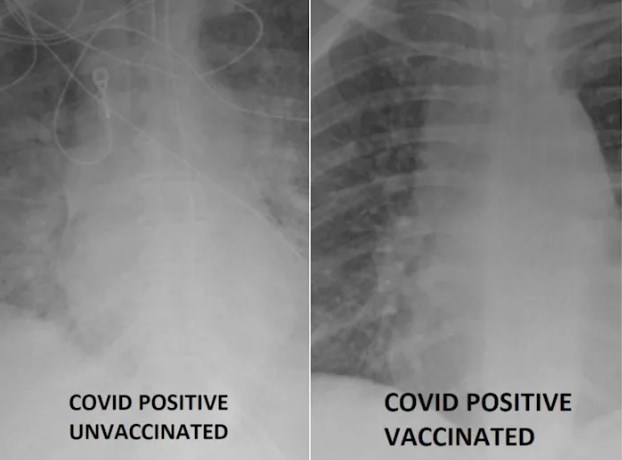 Kако изгледаат белите дробови на вакцинирано и невакцинирано лице позитивно на ковид-19